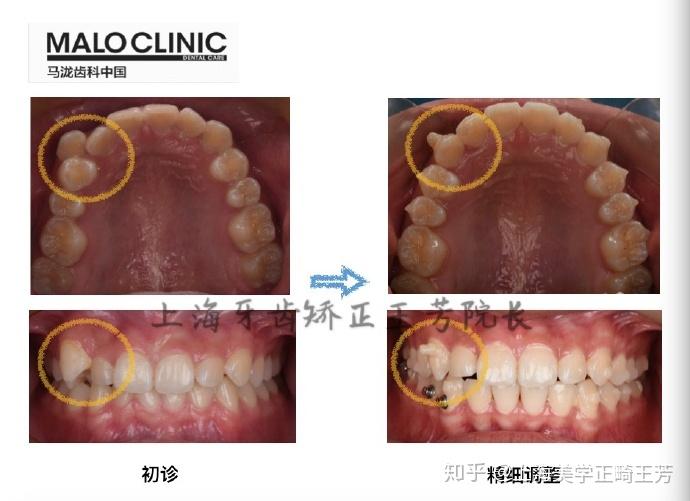 拔牙后嘴唇麻木八个月的经历与解析