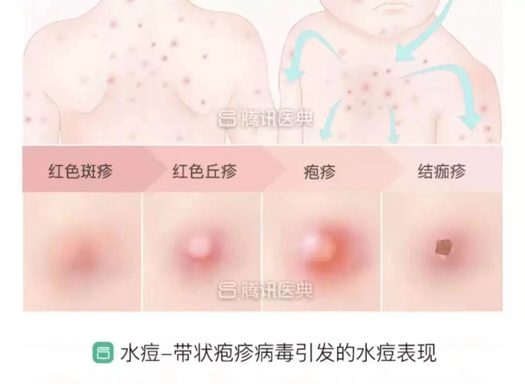 水痘疫苗接种时间解析，何时接种水痘疫苗？水痘几个月打？